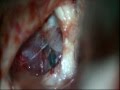 Brain tumor-craniophryngioma-microsurgical removal-dr suresh dugani/HUBLI/KARNATAK/INDIA