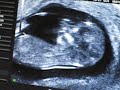 Ultrasound - 12 weeks, 2 days
