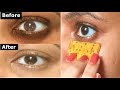 Banana Peel Under Eyes Before And After