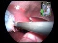 The fist transvaginal hibryd cholecystectomy on a porcine modell in Hungary - Long version