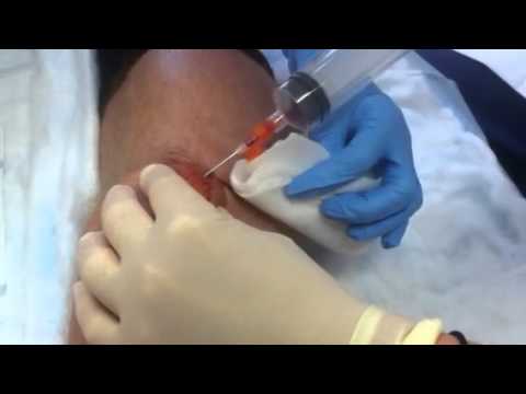 how to drain bursitis