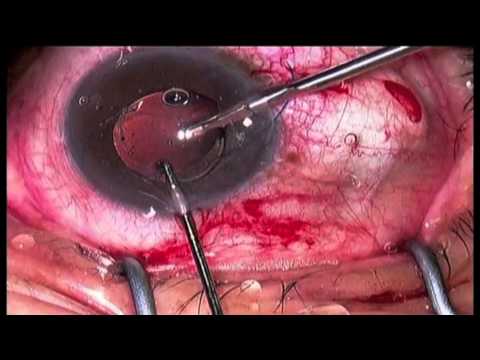 Trabecular aspiration and IOL exchange by Steven G. Safran MD