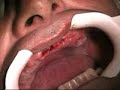 Maxillary Edentulous Arch Implant