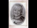 Achondroplasia