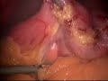 Laparoscopic Vertical Sleeve Gastrectomy