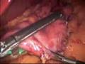 Laparoscopic Vertical Sleeve Gastrectomy