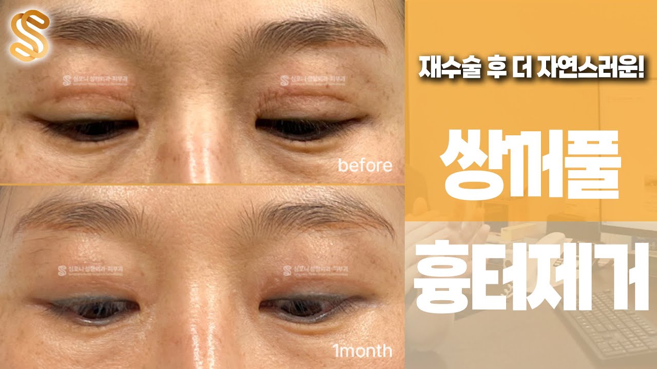 눈재수술이 반복될 수록 흉터도 더 심해질까요?