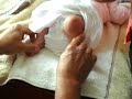 Clarise Clubfeet Physio-therapy