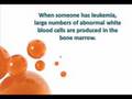 videos de Leukemia and Life