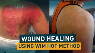 Progressive Wound Healing | Wim Hof Method ...