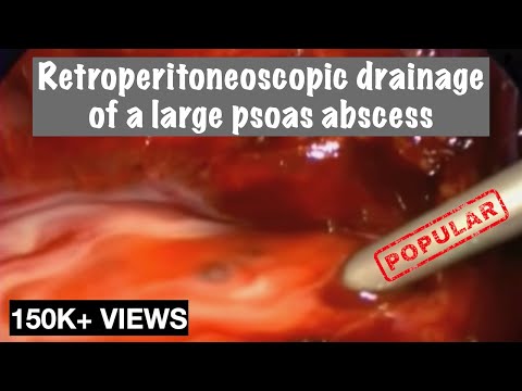 how to drain psoas abscess