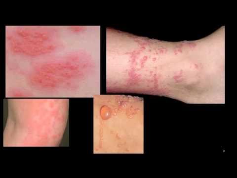 how to treat contact dermatitis