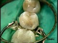 Restauraci�n de Posteriores Dr. P.Colon - Quixfil /2