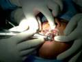 videos de computer guided implants in india