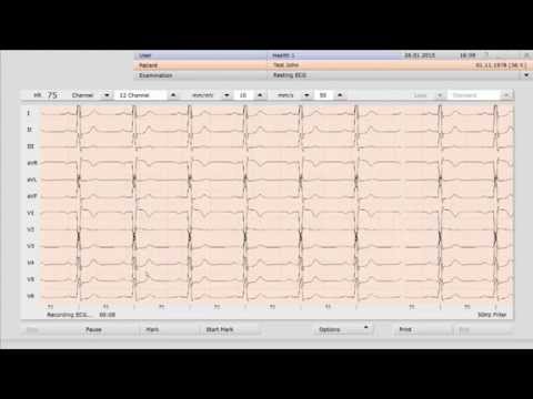 how to take ecg