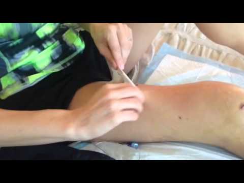 how to remove on q pain pump