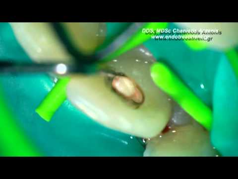 how to cure enlarged papillae