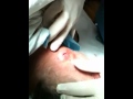 Pimple pop part 4