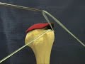 Arthroscopic Rotator Cuff Repair on a Model and on a Live Patient Arthroscopic Rotator Cuff Repair on a Model and on a Live Patient