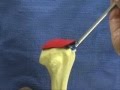 Arthroscopic Rotator Cuff Repair on a Model and on a Live Patient