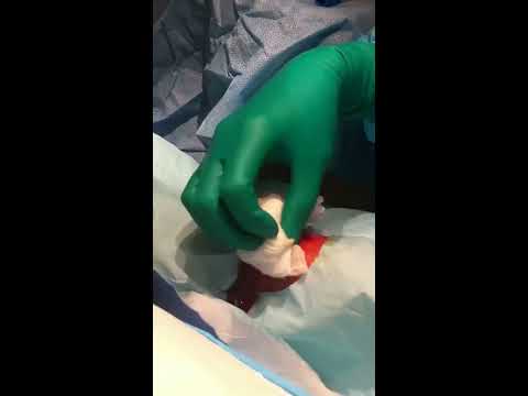 how to drain cellulitis