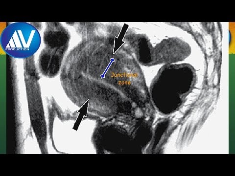 how to relieve adenomyosis pain
