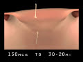 Abortifacient