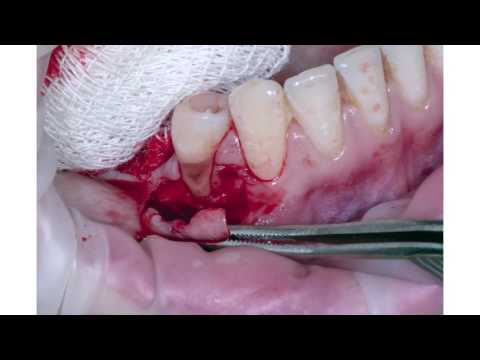 Практикум по пластике мягких тканей десны в области зубов и имплантатов. Часть 7