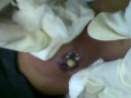 Absceso en brazo.