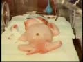 congenital dak
