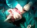 operating intestinal obstruction