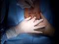 Minimally Invasive Penile Prosthesis.wmv