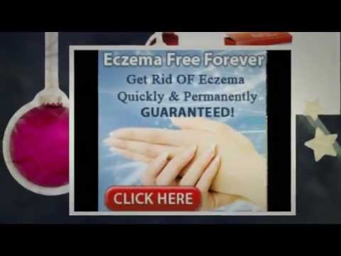 how to cure nummular eczema