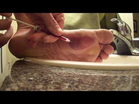 how to drain blister