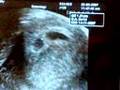 Having Twins ultrasound