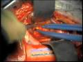 Brain surgery: Brain metastasis. www.cduma.com