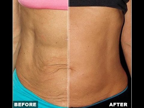 how to loose skin after pregnancy