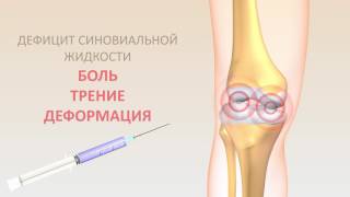 Чем восполнить жидкость в суставах Чем восполнить жидкость в суставах