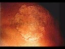 Hanseniase - UNIBAN