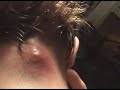 Horribly Gruesome Neck Wound In A 3 Day Span