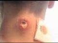 Horribly Gruesome Neck Wound In A 3 Day Span