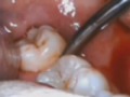 Dailymotion Extraction Des Dents De Sagesse Une Vidéo Hi Tech Et Science