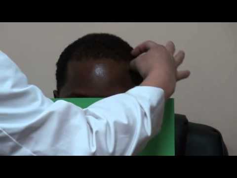 how to sleep after fue hair transplant