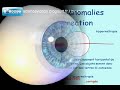 Anomalies de l'oeil: sciences videos