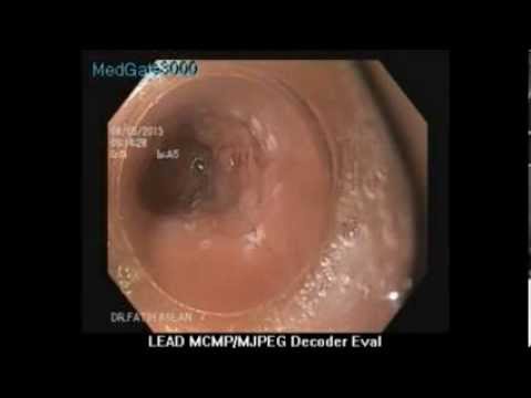 how to treat squamous cell carcinoma