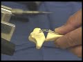 Osteotomy for Malunion