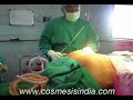 Cosmetic Surgery India - Dr.Surindher - Liposuction - Hips & Lower Back