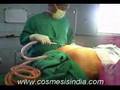 Cosmetic Surgery India - Dr.Surindher - Liposuction - Hips & Lower Back