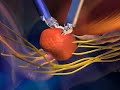 Prostate Cancer: daVinci Robotic Prostatectomy Prostate Cancer: daVinci Robotic Prostatectomy