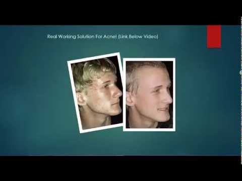 illuMask Review Anti-Acne LED Mask